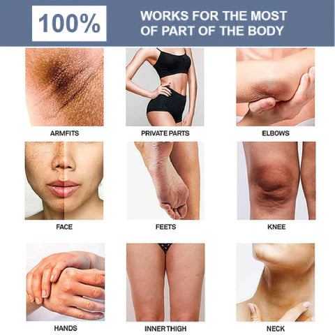 Cleansing Lotion for Acne & Spots & Nigricans, Skinenjoy Cleanser, Nigricans Cleansing Lotion for All Skin