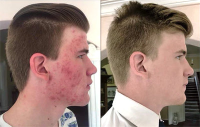 Cleansing Lotion for Acne & Spots & Nigricans, Skinenjoy Cleanser, Nigricans Cleansing Lotion for All Skin