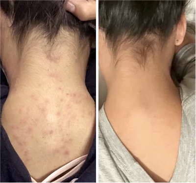 Cleansing Lotion for Acne & Spots & Nigricans, Skinenjoy Cleanser, Nigricans Cleansing Lotion for All Skin