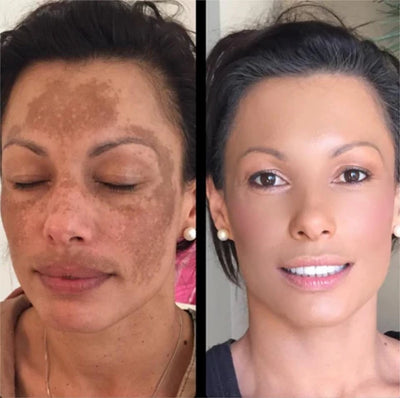 Cleansing Lotion for Acne & Spots & Nigricans, Skinenjoy Cleanser, Nigricans Cleansing Lotion for All Skin